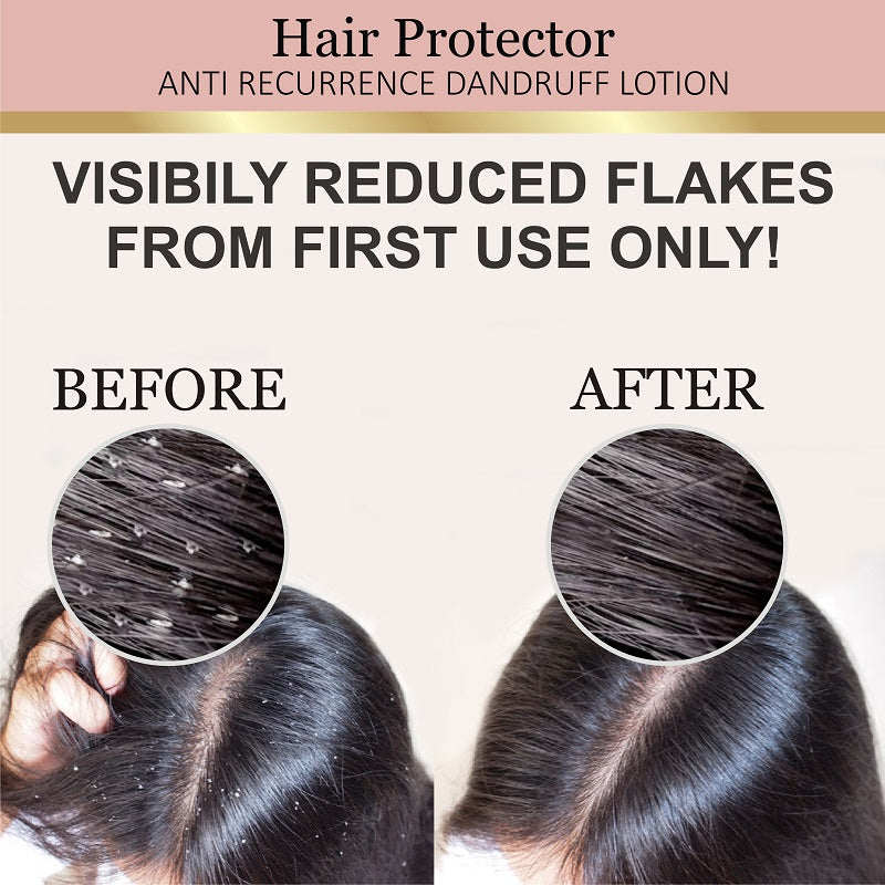 Hair Fall Control & Hair Growth Anti Recurrance Dandruff Lotion - 30ml